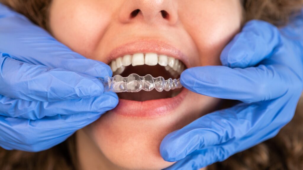 Invisalign