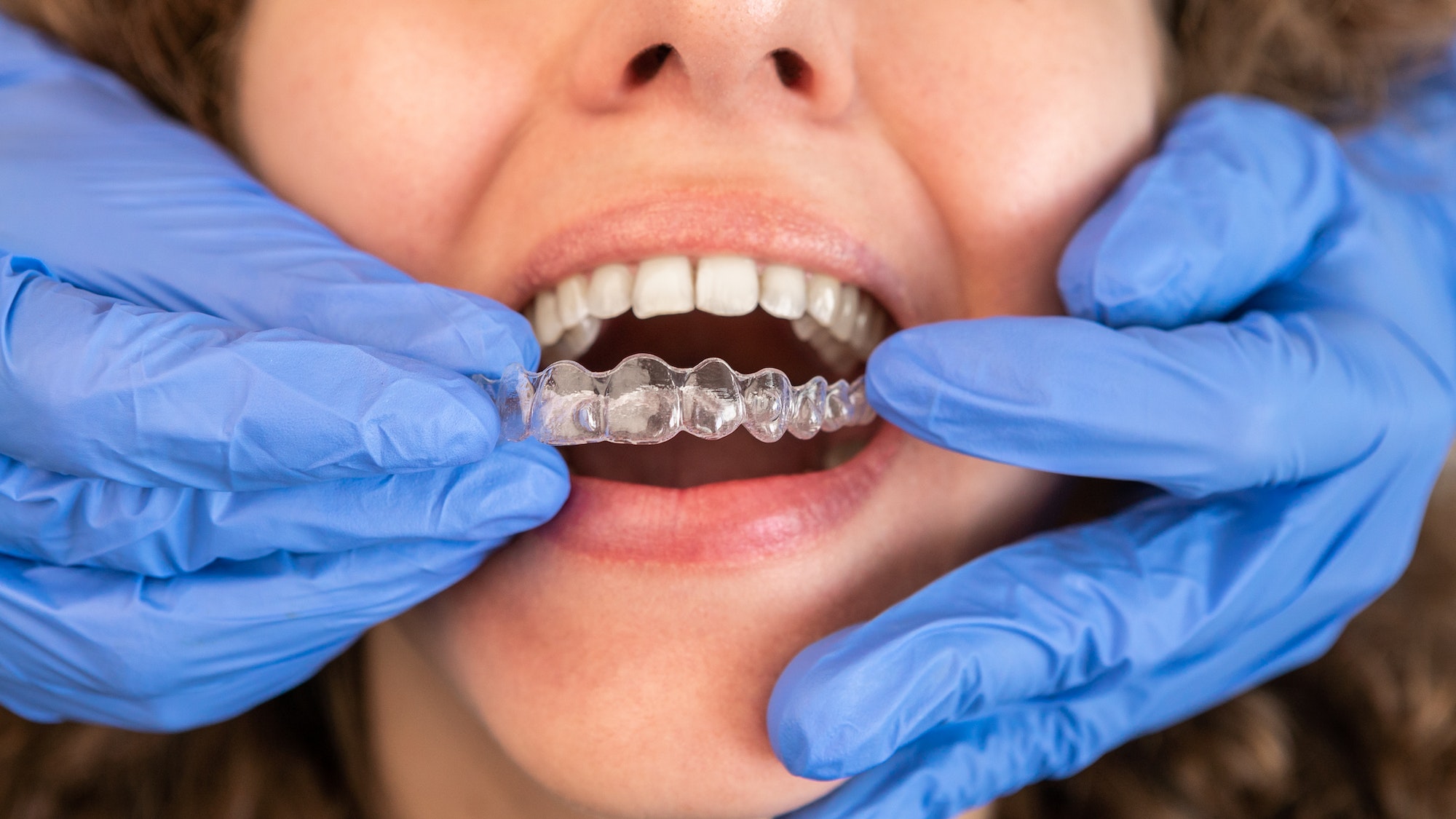 Straighten Your Smile with Invisalign: The Preferred Choice For Clear Aligners